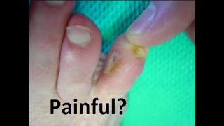 Heloma Molle Corn on Foot Home Treatment Guide [upl. by Arraes]