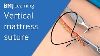 Vertical Mattress Suture  BMJ Learning [upl. by Piero186]