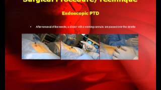 Posterolateral Endoscopic Thoracic Microdiscectomy with GPS System [upl. by Neelie723]