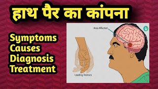 hath pair ka kapna tremortreatment diagnosis symptoms causes doctor health [upl. by Aniled]