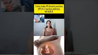 twins baby ki breech position hone par c section delivery kyu krani chahiye twins baby ki delivery [upl. by Racso]