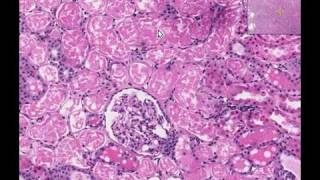 Histopathology Kidney Acute tubular necrosis [upl. by Ariaz474]