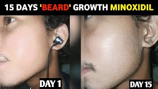 15 days beard growth minoxidil journey  minoxidil review beard growth  man matters beard oil [upl. by Marchal]