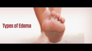 8 Types of Edema [upl. by Alfonzo]