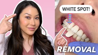 How to Remove WHITE SPOTS on Your Teeth  Dr Joyce Kahng [upl. by Alber]