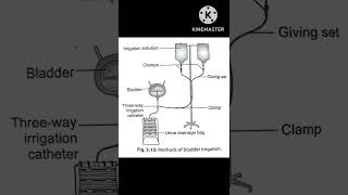 bladder irrigation [upl. by Hermia]