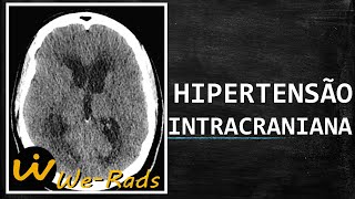 Como Identificar Hipertensão Intracraniana na Tomografia [upl. by Steiner]