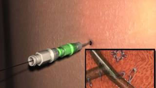 Biliary tract Introducer Setmpe [upl. by Ebbarta]