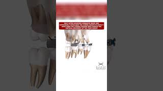 CANINES OVER THE ROOTS OF THE LATERAL INCISORS  ORTHODONTIC TIPS Shorts [upl. by Lativa101]