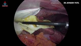 HYDATID CYST LIVER [upl. by Etnohs505]