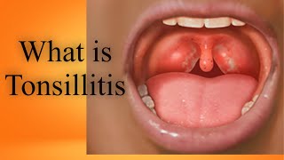 What is Tonsillitis Tonsils Kia hain Bachun me tonsils ka ilaj in UrduHindi [upl. by Ybrik]