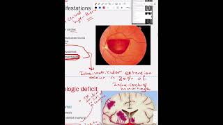 Intracerebral Hemorrhage  Part 2 [upl. by Ruphina]