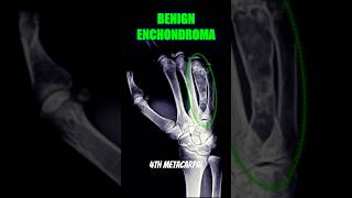 Enchondroma bones xray health [upl. by Ojeillib929]