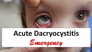 Acute Dacryocystitis Emergency [upl. by Garibald]