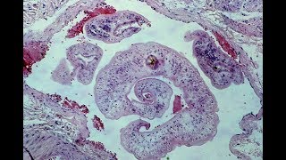 Schistosomiasis  Pathology mini tutorial [upl. by Llennaj]