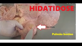 Hidatidose  Cisto Hidático viavel [upl. by Hatti]