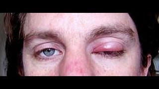 How To Get Rid Of A Stye  how to get rid of styes  eye stye treatment [upl. by Charlie]