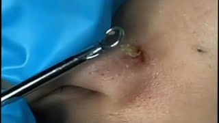 Big Cystic Acne Blackheads Extraction  Blackheads amp Milia  Whiteheads amp Comdones  Pimple Popping [upl. by Ameen]