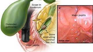 Cholecystitis Dr Fady Magdy افضل وأوضح شرح لألتهاب المراره د فادي مجدي [upl. by Ennaeus]