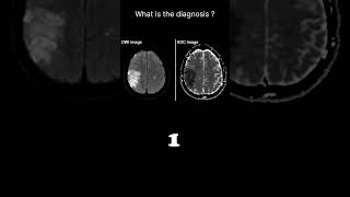 Diffusion weighted imaging – Infarct brain Quiz 19 radiologychannel007 [upl. by Ambrosius]