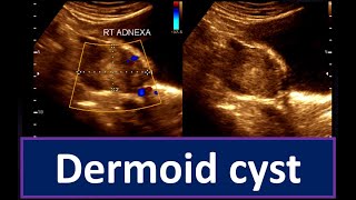 Understanding Dermoid Cyst  Guide to Ultrasonogram Diagnosis Ovarian Cyst  Practical Ultrasonogram [upl. by Ena]