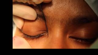 Lacrimal probing and syringing [upl. by Ahsitahs]