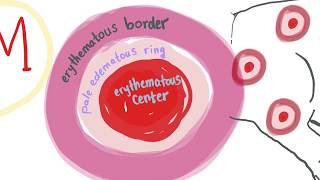 Erythema Multiforme with mnemonic  ALL you need to know [upl. by Tdnarb]