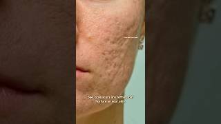 How to get rid of acne scars with Tretinoin  Acne scar Treatment sristydutta acnescars shorts [upl. by Akeem]