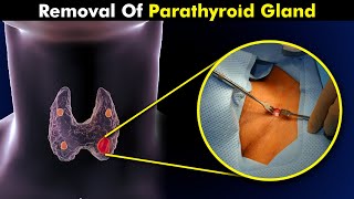 How Parathyroidectomy is Performed  Removal Of Parathyroid Gland [upl. by Maletta912]