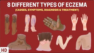 Eczema Exposed 8 Types You Need to Know [upl. by Stannfield]