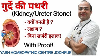 Kidney ।ureter stone  गुर्दे की पथरी  homeopathic treatment without surgery [upl. by Noram]