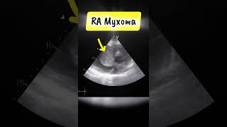 Parasternal short Axis View showing RA myxoma on Echocardiography heart tumor [upl. by Steffy]