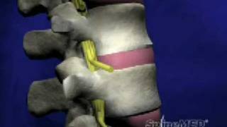 SpineMED® Decompression System Patient Education Video [upl. by Higinbotham]