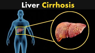 What is liver cirrhosis  Symptoms Diagnosis and treatment 3D Animation [upl. by Horner]