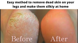 Remove dead skin from your feet in 5 minutesquotEasiest method at homequot [upl. by Song489]