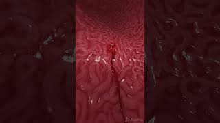 Bleeding gastric ulcer 3d animation anatomy meded [upl. by Hestia445]