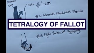 How to understand the Tetralogy Of Fallot [upl. by Enayr]