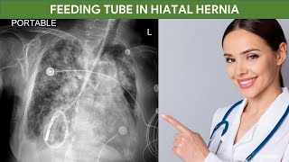 Feeding Tube in Hiatal Hernia Mimics Intrapulmonary Tube Placement in Chest Xray [upl. by Keeton]