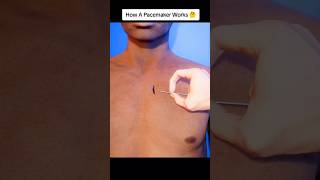 How a Pacemaker Works in Your Body health yourbody facts pacemaker heartmonitoring cardiac [upl. by Hametaf]