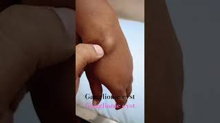 ganglionic cyst [upl. by Eilahtan]