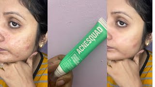 AcneSquad Breakout terminator spot Corrector ReviewHow to get rid of Acne and Pimples [upl. by Nahgen349]