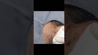 An Ear Cyst You Dont Want to Miss [upl. by Falcone]