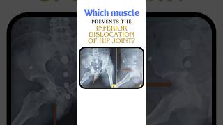 Which muscle prevents the inferior dislocation of hip joint Hip dislocation shorts hipjoint [upl. by Snodgrass]