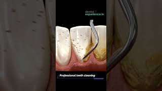 Tooth Cleaning  Teeth Scaling I stain or Tartar Removal cost  Dentalexperiencein [upl. by Natsyrk57]