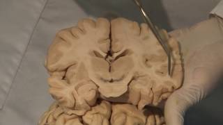 Cortical Localization Neuroanatomy Video Lab  Brain Dissections [upl. by Ynnus]