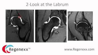 How to Read a Hip MRI Top 3 Things to Know [upl. by Rombert351]