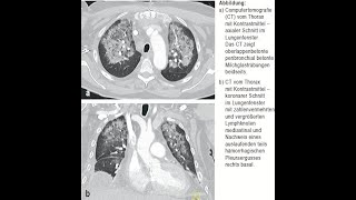 Daptomycin assoziierte eosinophile Pneumonitis [upl. by Michey642]