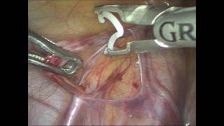 Laparoscopic varicocelectomy using polymer ligating clips [upl. by Eenahc295]