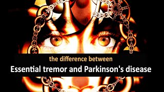 The difference between essential tremor and Parkinsons disease [upl. by Cormick]