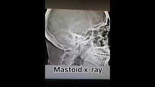 mastoid x ray ear x ray radiology shortvideo [upl. by Aihsekel457]